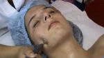 diofrecuencia Indiba facial